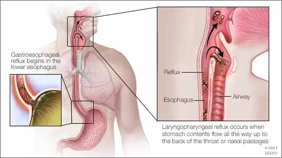 a medical illustration of gastroesophageal reflux and layrngopharyngeal reflux