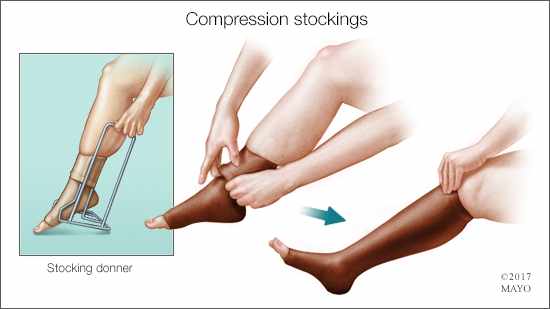 a medical illustration of putting on compression stockings