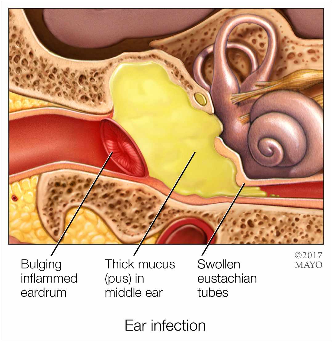 a medical illustration of an ear infection with eardrum, middle ear and eustachian tubes