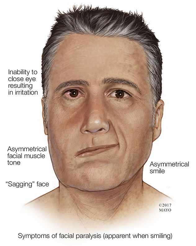 a medical illustration of a man with facial paralysis 