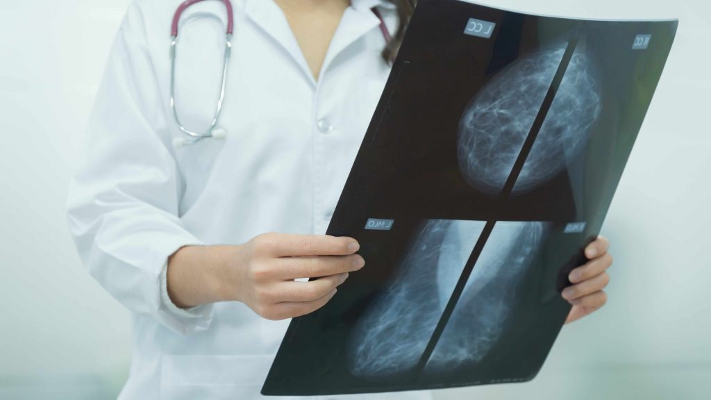Una doctora sostiene en las manos las imágenes de la mamografía