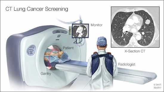 a medical illustration of a CT lung cancer screening