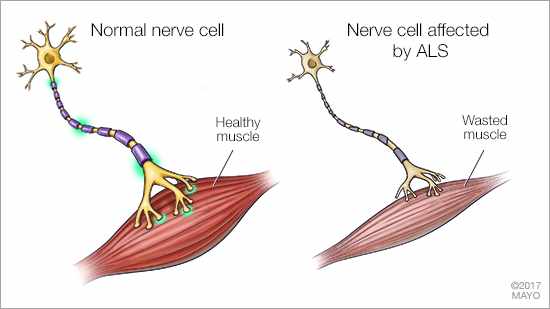 a medical illustration of a normal nerve cell and healthy muscle, and a nerve cell affected by ALS and wasted muscle