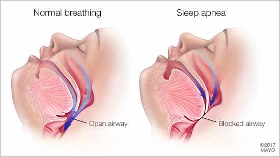 a medical illustration of normal breathing with an open airway, and sleep apnea with a blocked airway