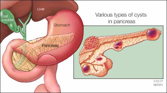 Ilustración médica de varios tipos de quistes pancreáticos