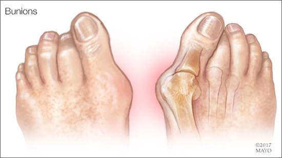 a medical illustration of bunions
