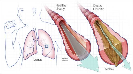Ilustración médica de la fibrosis quística