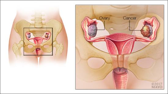 Ilustración médica del cáncer de ovario