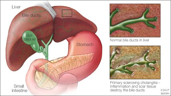 Ilustración médica de la colangitis esclerosante primaria