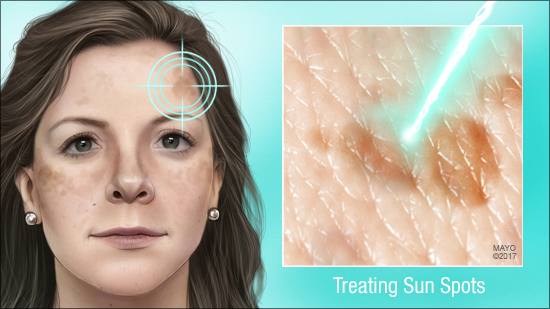 a medical illustration of sunspots on a woman's face