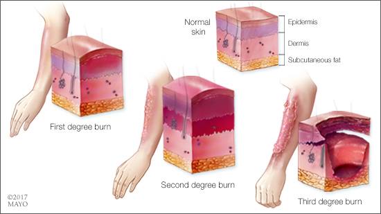 Ilustración médica de las capas de la piel cuando es normal y con quemaduras de primero, segundo y tercer 