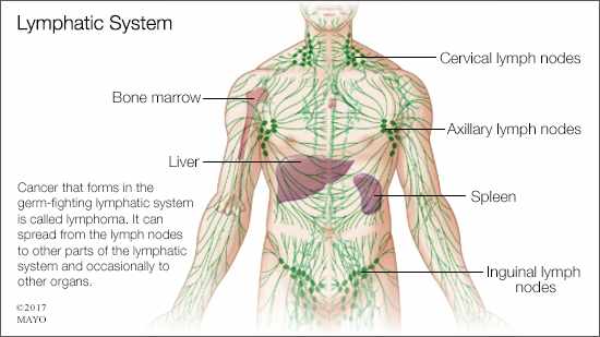 a medical illustration of the lymphatic system and lymphoma