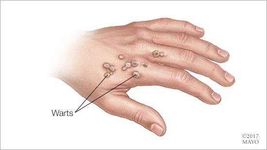 Ilustración médica de verrugas en la mano