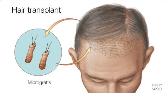 a medical illustration of hair transplants using micrografts