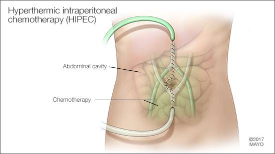 Ilustración médica de la quimioterapia intraperitoneal hipertérmica (HIPEC) 