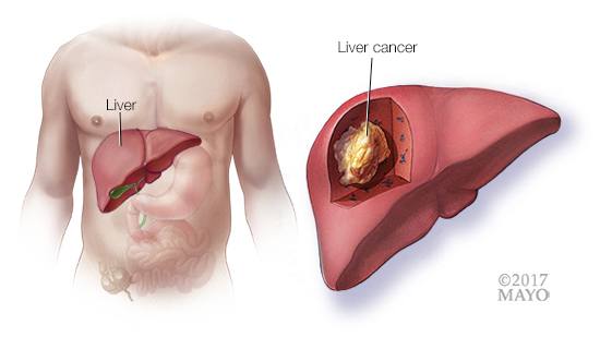 a medical illustration of liver cancer