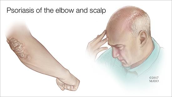 Ilustración médica de un hombre con psoriasis en el codo y en el cuero cabelludo 