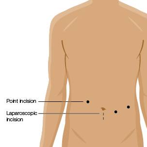 infographic for minimally invasive pancreatic cancer surgery