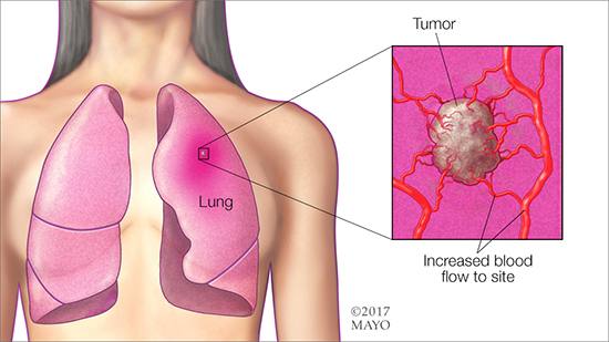 a medical illlustration of lung cancer