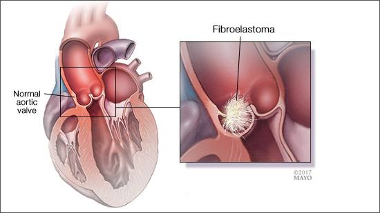 a medical illustration of a normal aortic heart valve and one with a fibroelastoma
