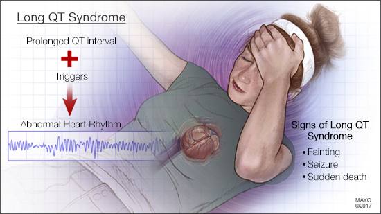 Ilustración médica del síndrome del intervalo QT largo 