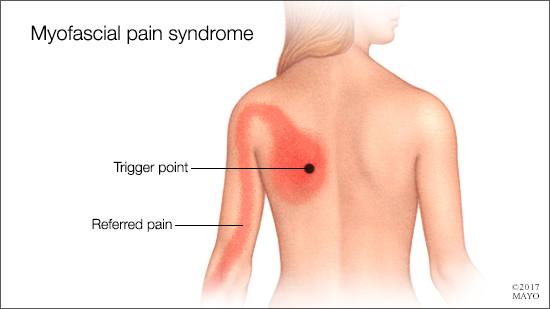 Ilustración médica de los posibles puntos dolorosos en la fibromialgia