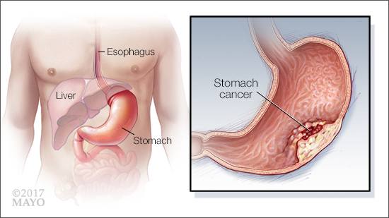 a medical illustration of stomach cancer