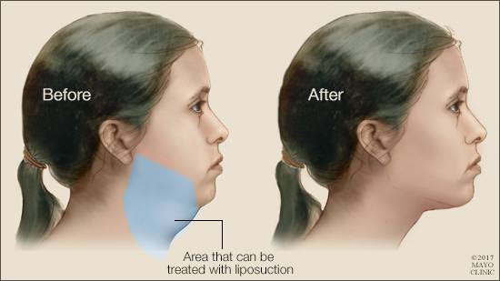 Ilustración médica de los resultados de la liposucción en el mentón y cuello de una mujer. 