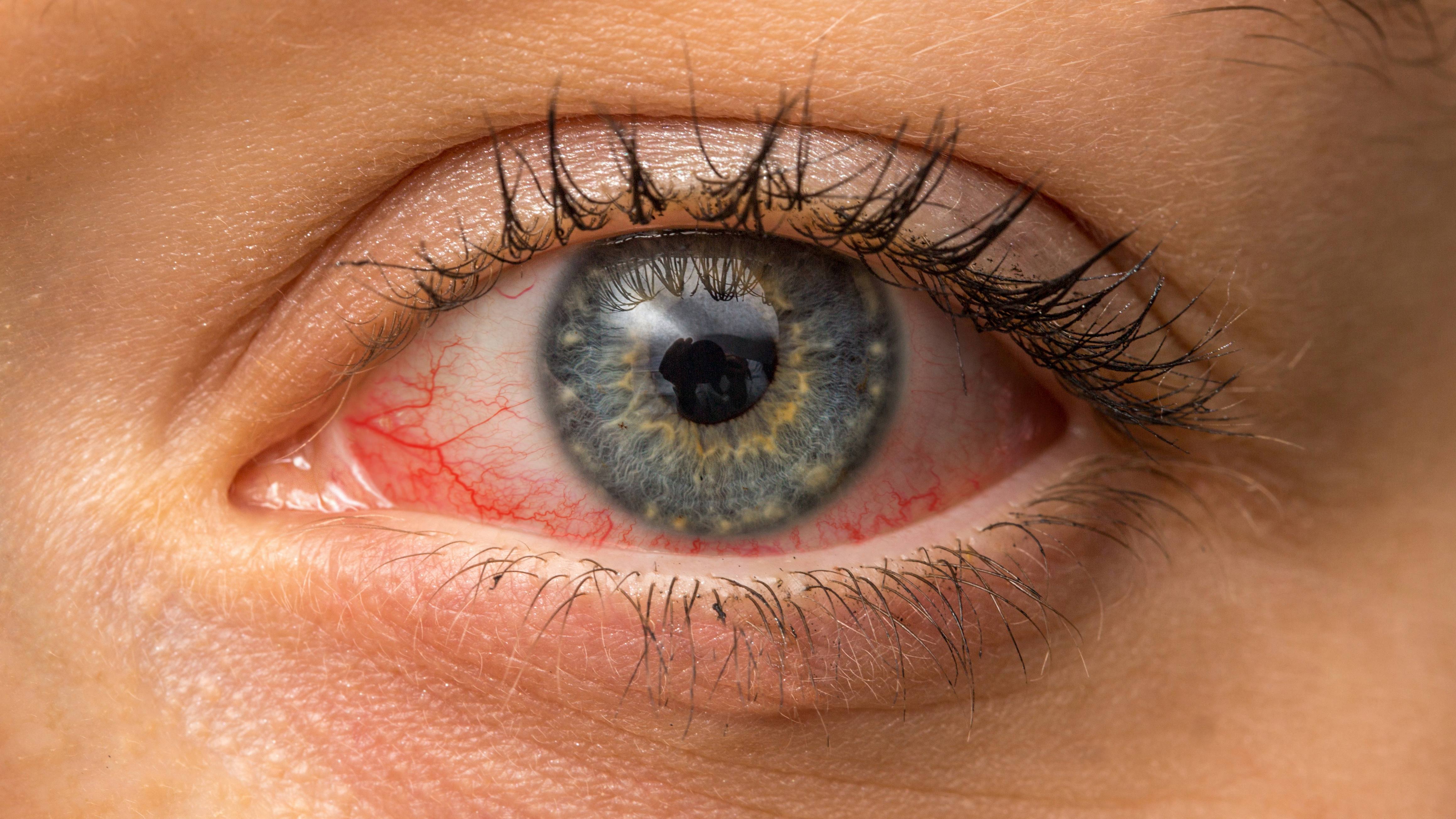 a person with red, sore and itchy eyes, maybe pick eye, conjunctivitis