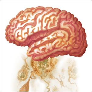 a medical illustration of a healthy brain and one with Alzheimer's disease