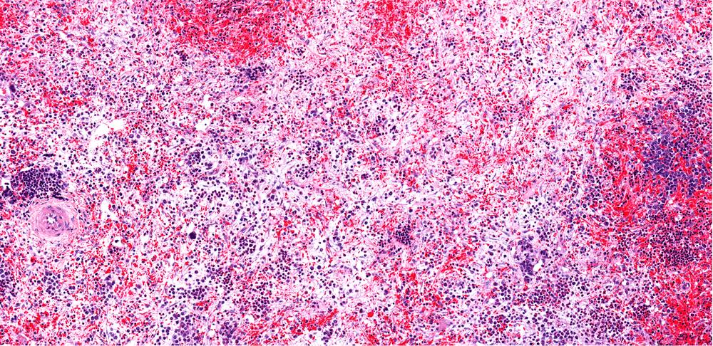 Myelofibrosis of the bone marrow with replacement of normal marrow by fibrous connective tissue