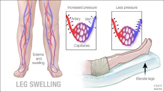 Gráfico médico de edema e hinchazón de la pierna 