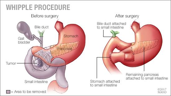 a medical illustration of a Whipple procedure, or pancreaticoduodenectomy