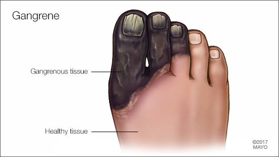 Ilustración médica de gangrena en los dedos del pie