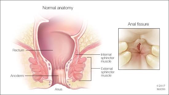 Ilustración médica de un recto y un ano con anatomía normal y de la fisura anal