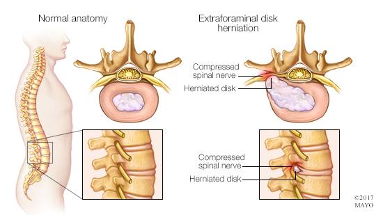 a medical illustration of normal spinal anatomy and a herniated disk