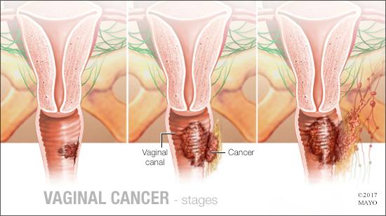 a medical illustration of the stages of vaginal cancer