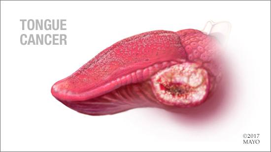 a medical illustration of tongue cancer