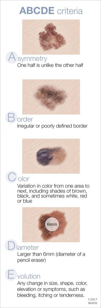 an image of the ABCDE criteria used to identify characteristics of unusual moles that may indicate melanomas or other skin cancers