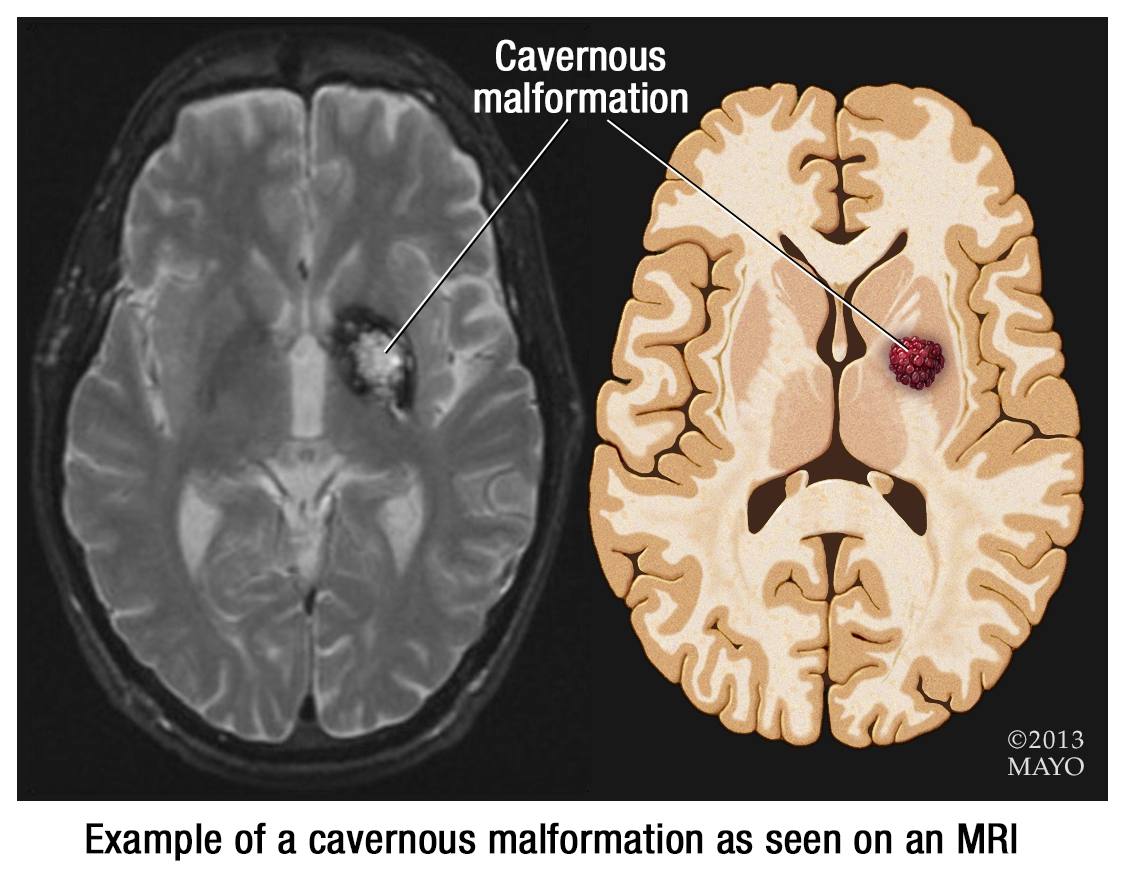 MRI of brain showing cavernous malformation
