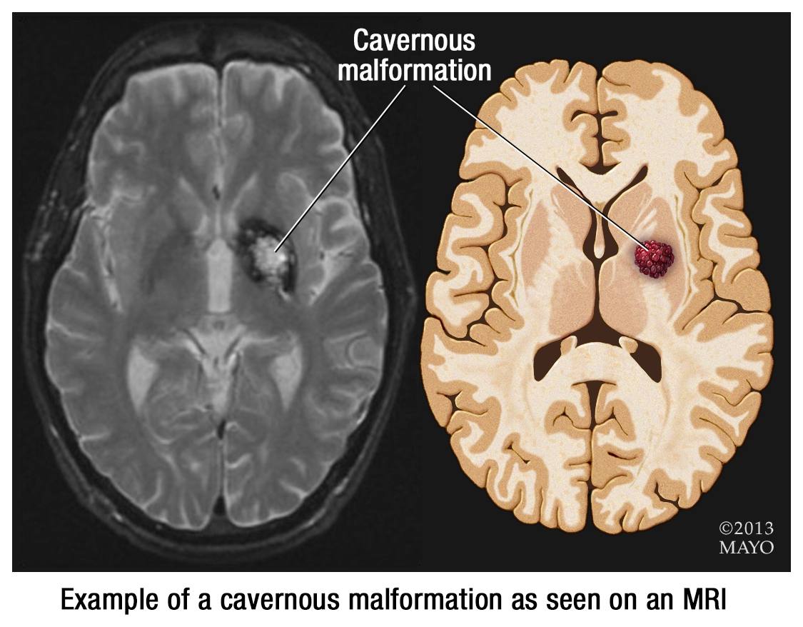 Cavernous Hemangioma Brain Brain Cavernous Malformation CM Boston