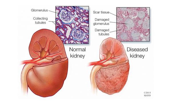 medical illustration of healthy and diseased kidneys