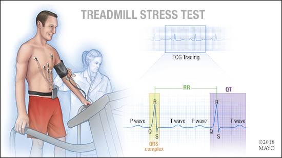 a medical illustration of a treadmill stress test