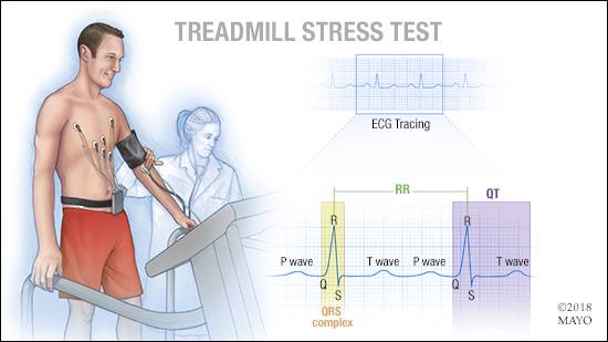 Mayo Clinic Q And A Exercise Stress Test To Diagnose Heart Issues 