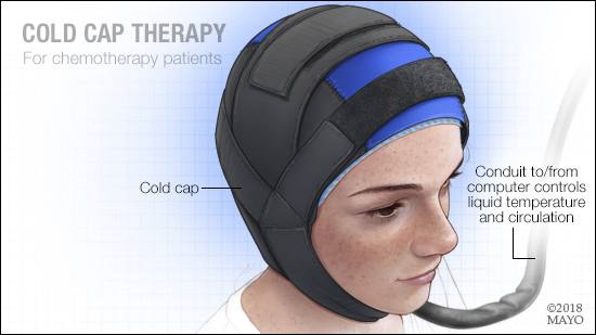 Ilustración médica de la terapia con gorro hipotérmico para pacientes de quimioterapia