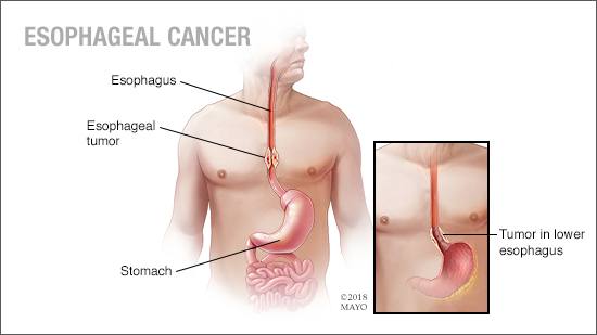 a medical illustration of esophageal cancer