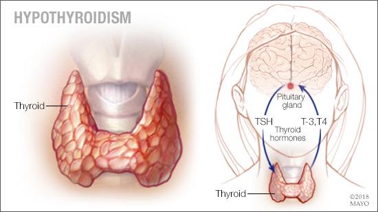 Ilustración médica del hipotiroidismo