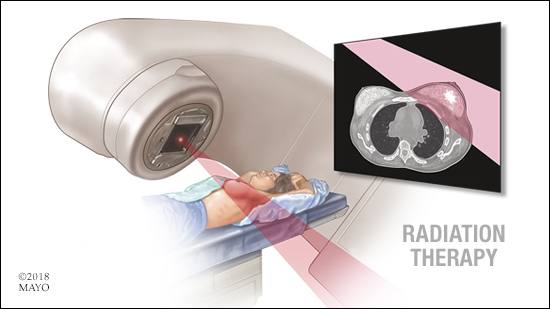 a medical illustration of radiation therapy