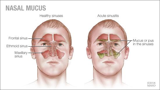 a medical illustration of the sinuses and nasal mucus