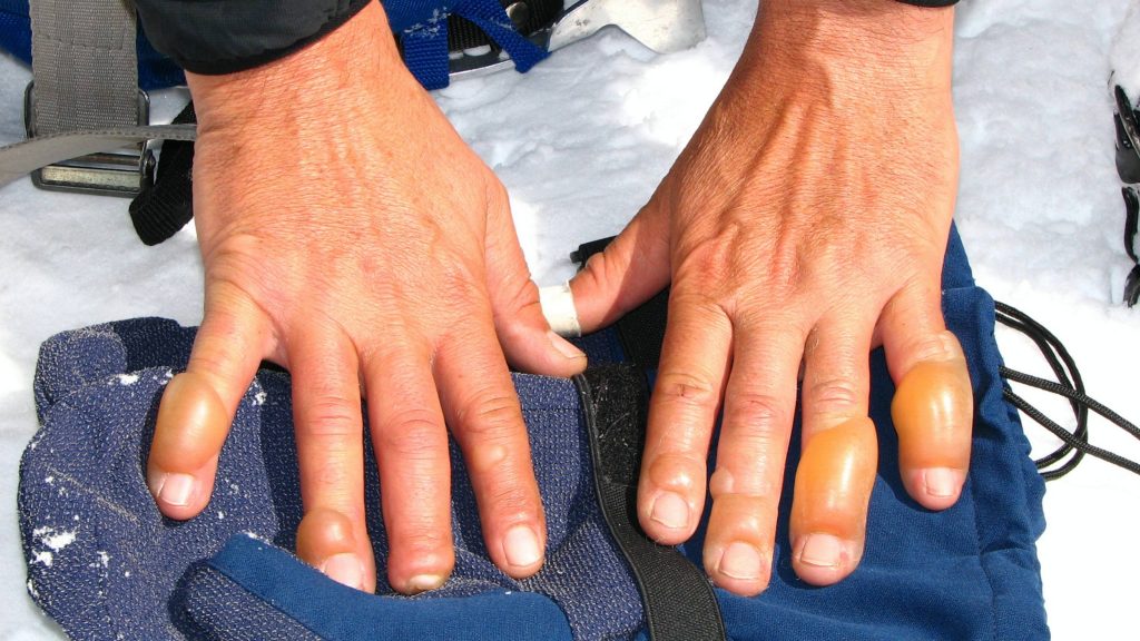 closeup of hands swollen and suffering in the cold from frostbite